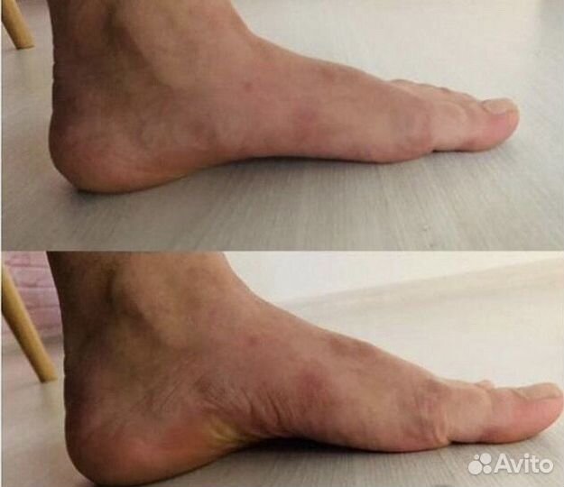 Плоскостопие коррекция