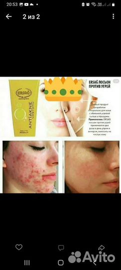 Ср-во против угрей и прыщей,убирает растяжки рубцы