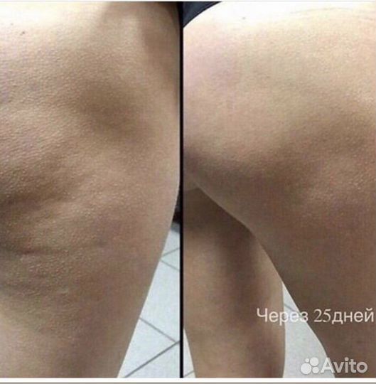 Антицеллюлитный крем