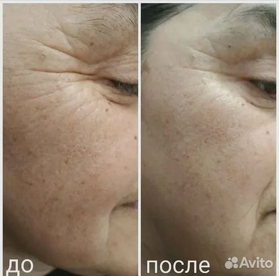 Лифтинг система sharm - аналог Скиндалженс (NHT)