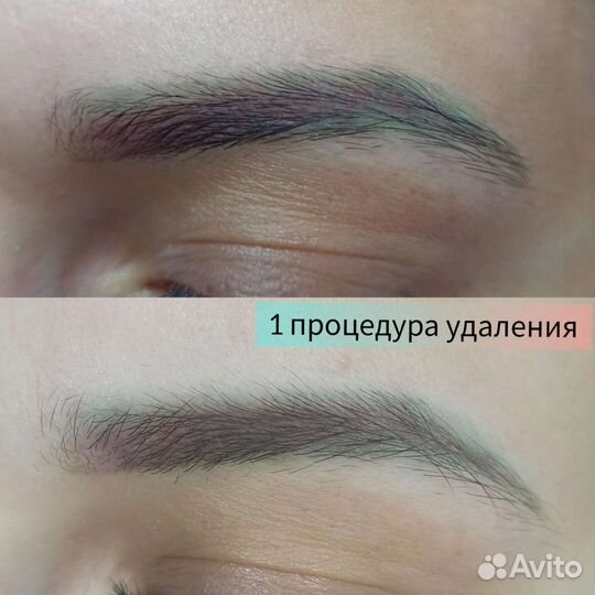 Удаление татуажа и татуировок ремувером