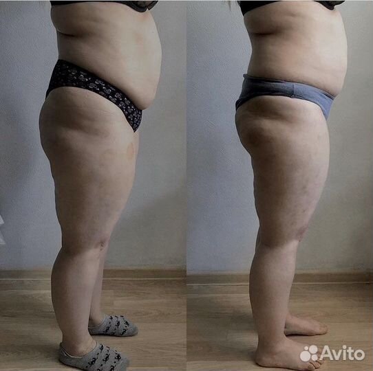 Массаж, похудение