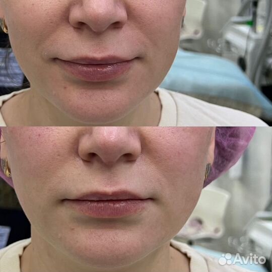 Смас-лифтинг Ультраформер (Ultraformer)