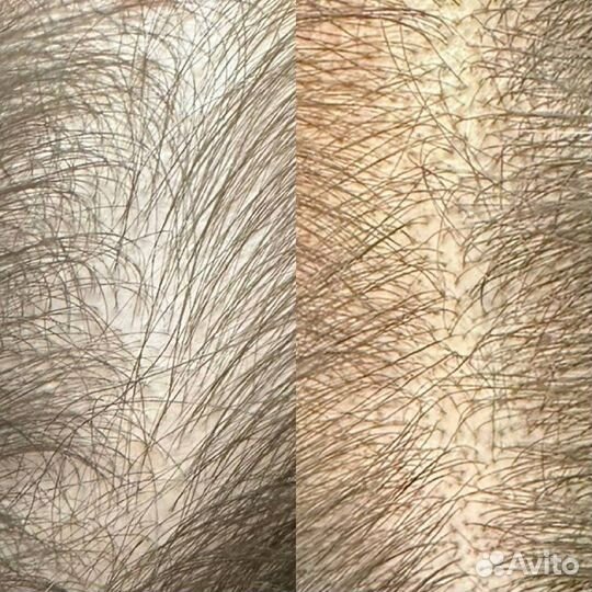 Камуфляж растяжек, удаление шрамов