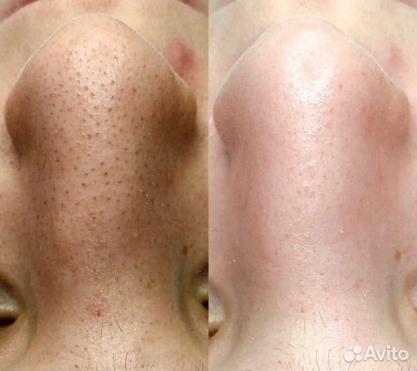 Наращивание ресниц. Косметические процедуры