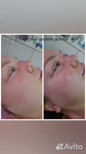 УЗ чистка,Кавитация, вакуумный массаж, рф-лифтинг