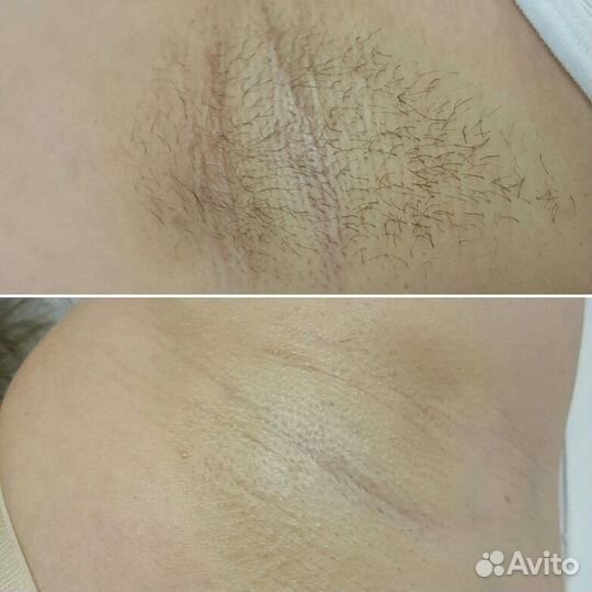 Депиляция на дому