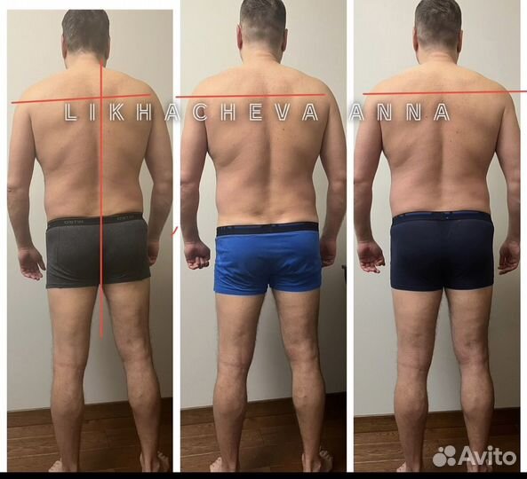 Остеопластика - мягкая правка тела и лица