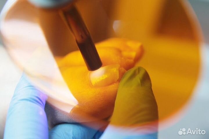 Подолог, установка титановые нити