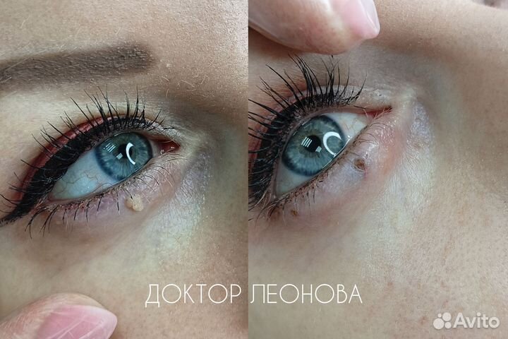 Удаление родинок папиллом у дерматолога