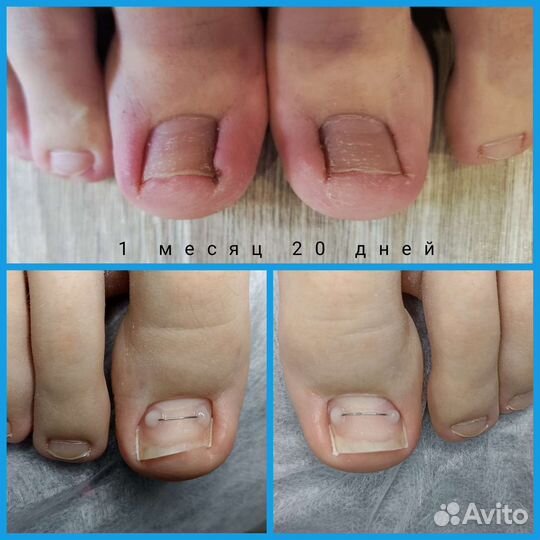 Установка титановой нити