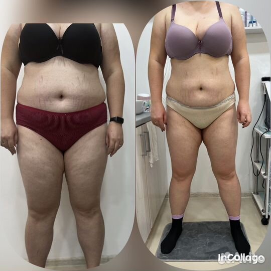 Аппаратный массаж