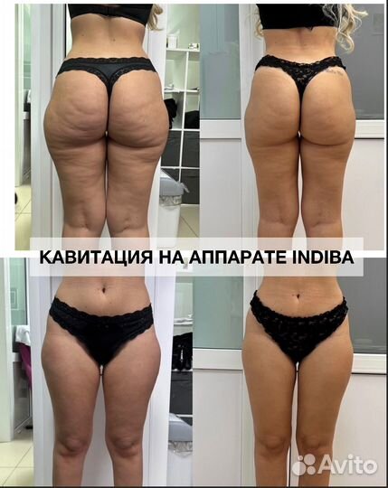 Криолиполиз Кавитация РФ Лифтинг