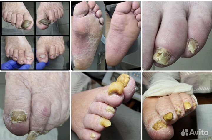 Услуги подолога. Работа с проблемами ногтей и стоп