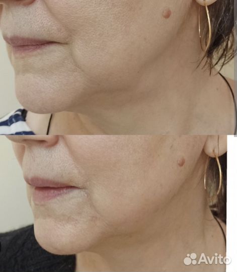 Плазмолифтинг