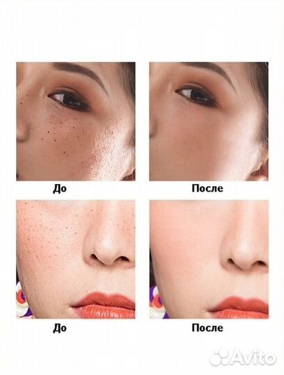 Лазерная машинка для удаления черных точек новая