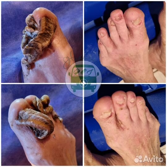 Парамедицинский педикюр пожилым с выездом на дом