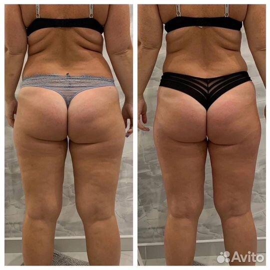 Аппаратный массаж тела