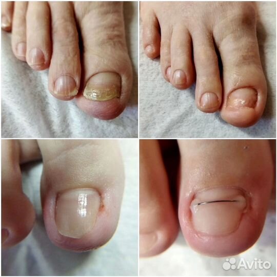 Лечебный педикюр подолог