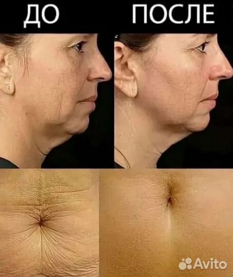 Коррекция фигуры/RF-лифтинг/Кавитация/Обертывание