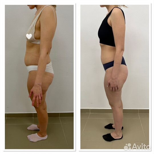 LPG-массаж на аппарате Vortex