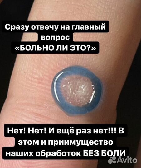 Вросший ноготь Подолог