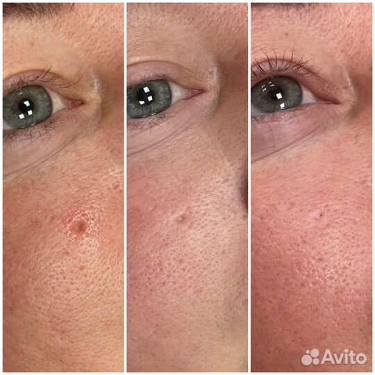 Лазерная шлифовка