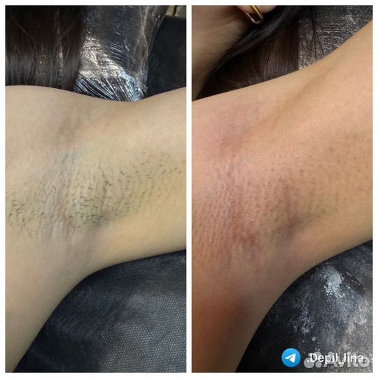 Депиляция шугаринг