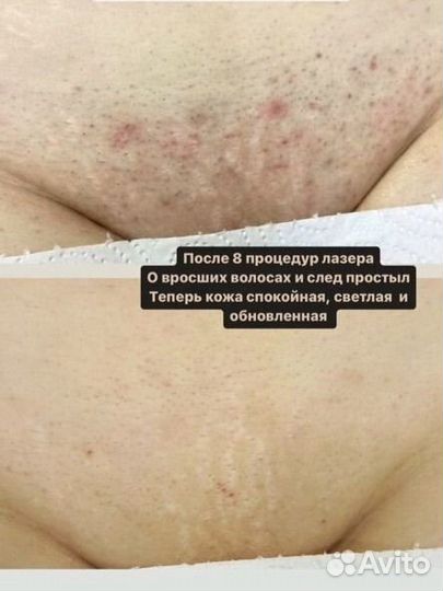 Лазерная эпиляция