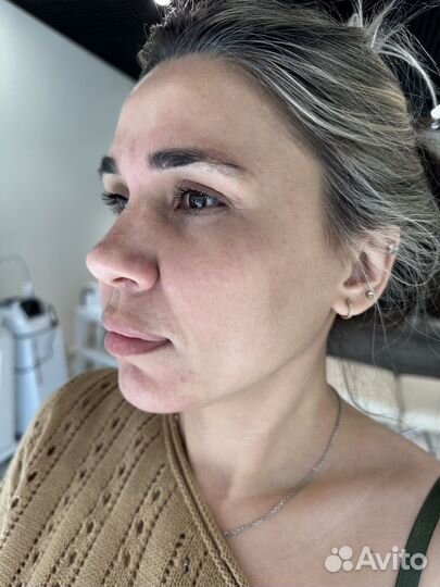 Обучение Микроигольчатый RF лифтинг