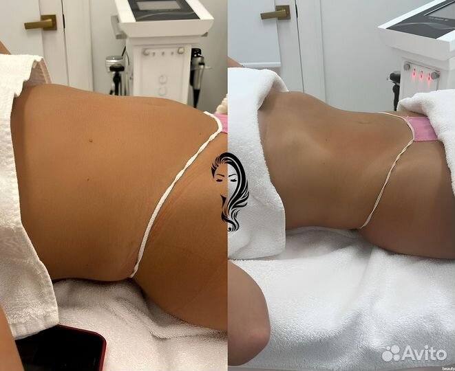 Криолиполиз LPG массаж Коррекция фигуры