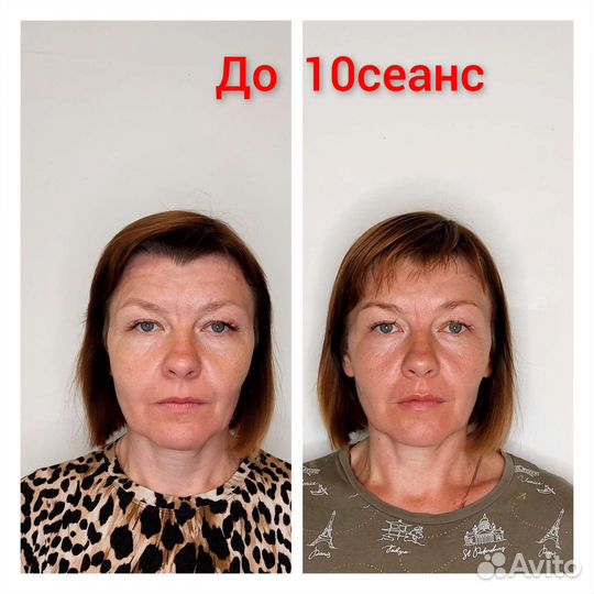 Лифтинг-массаж лица