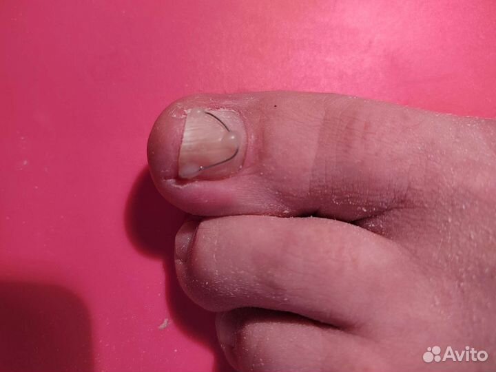 Педикюр, подология/титановая нить