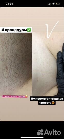 Лазерная эпиляция для женщин и мужчин