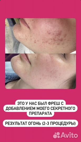 Мезотерапия лица