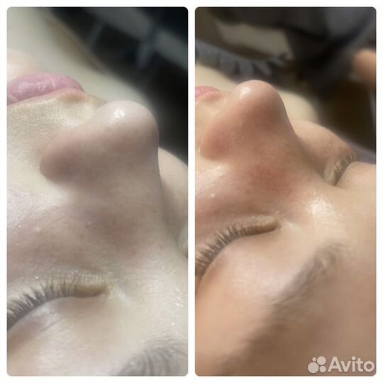 Дарсонвализация