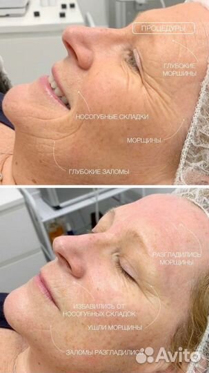 Игольчатый РФ лифтинг РФ лифтинг