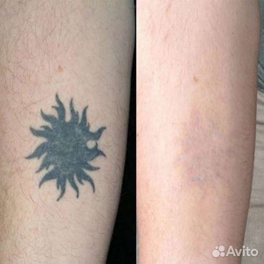 Лазерное удаление татуировок