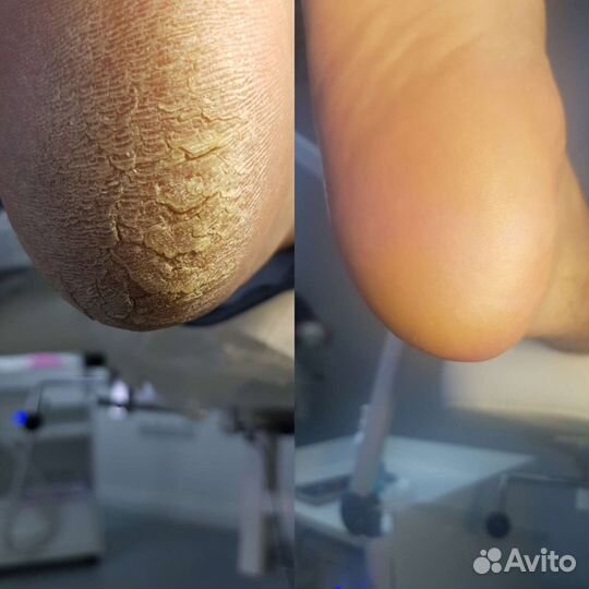 Аппаратный педикюр