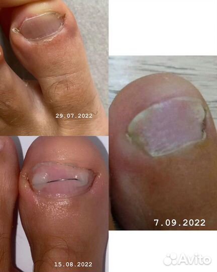 Подолог Медицинский педикюр Вросший ноготь