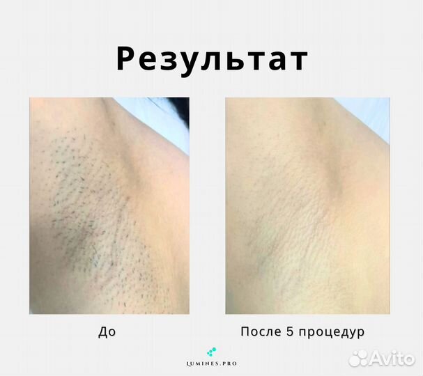 Аппарат для эпиляции Лю-Минес Макс’Ван 1200в