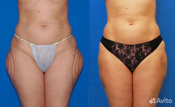 Лимфо дренажный массаж тела