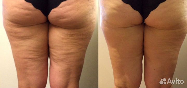 Антицеллюлитный массаж
