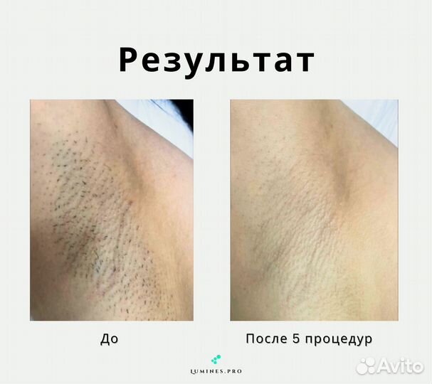 Диодный лазер для эпиляции Лю’минес Макс Ван 1200в