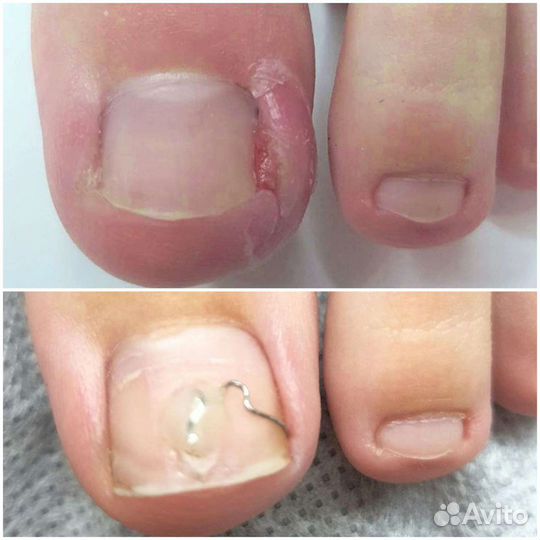 Аппаратный педикюр