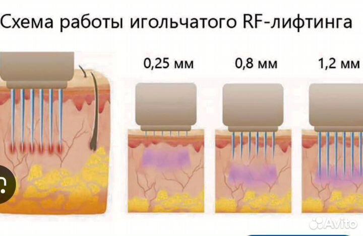 Игольчатый РФ лифтинг