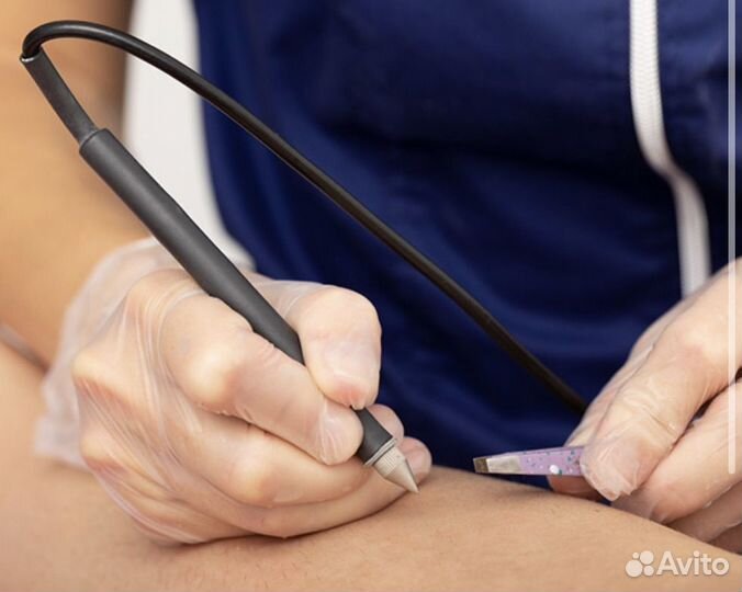 Электроэпиляция