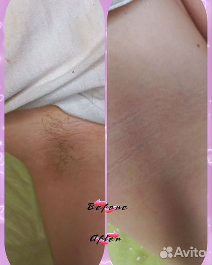 Шугаринг и восковая депиляция