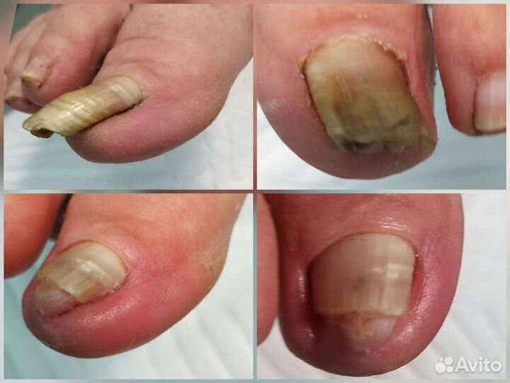 Подология лечение ногтей