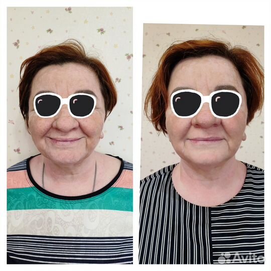 Вакуумный аппаратный массаж, кавитация, Rf-лифтинг